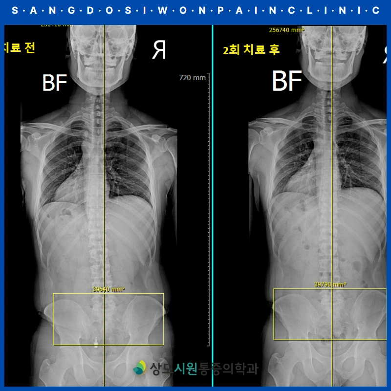 치료 전과 2회 치료 후의 전신 엑스레이 비교. 척추 무게중심선을 기준으로 좌우 기울기와 골반 높이가 달라진 모습