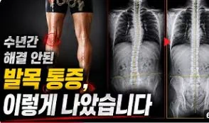 수년간 해결 안된 발목 통증 치료 유튜브 영상 썸네일